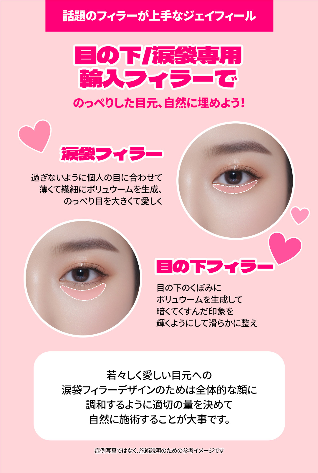 Filler túi lệ hướng đến vùng mắt trẻ thơ tự nhiên｜Sử dụng kim cannula giảm đau｜Seoul Hongik Univ. stn.・Phòng khám Jfeel Hongdae