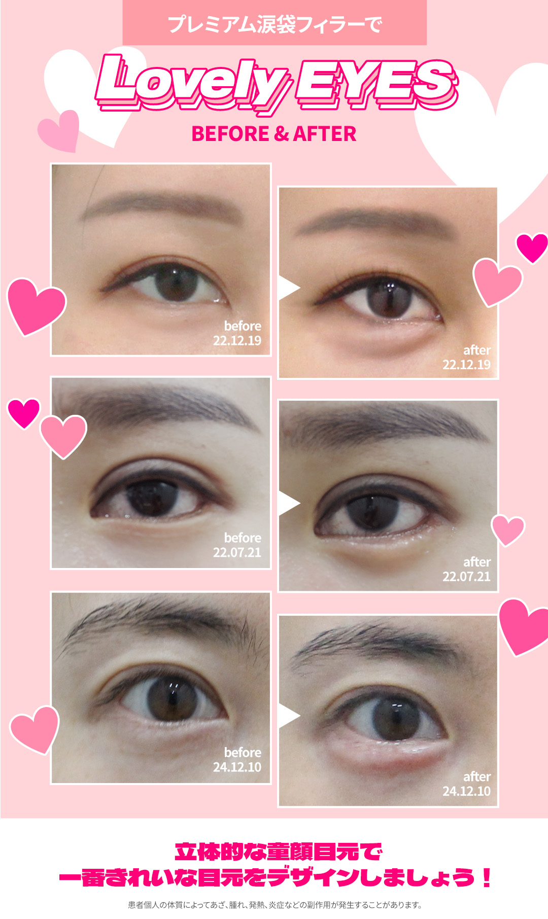 Filler túi lệ hướng đến vùng mắt trẻ thơ tự nhiên｜Sử dụng kim cannula giảm đau｜Seoul Hongik Univ. stn.・Phòng khám Jfeel Hongdae