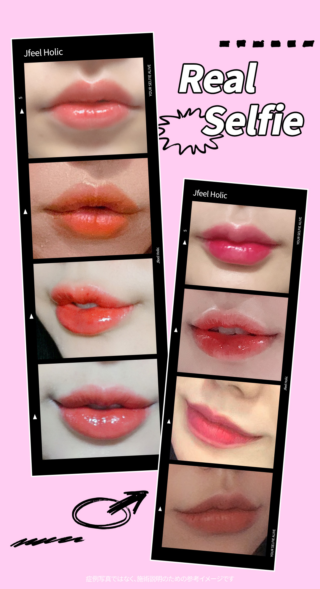 Filler khóe miệng & Botox hướng đến ấn tượng nụ cười tự nhiên｜Thủ thuật thiết kế chọn từ 3 loại｜Phòng khám Jfeel Hongdae