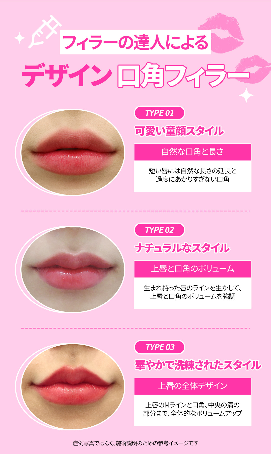 Filler khóe miệng & Botox hướng đến ấn tượng nụ cười tự nhiên｜Thủ thuật thiết kế chọn từ 3 loại｜Phòng khám Jfeel Hongdae