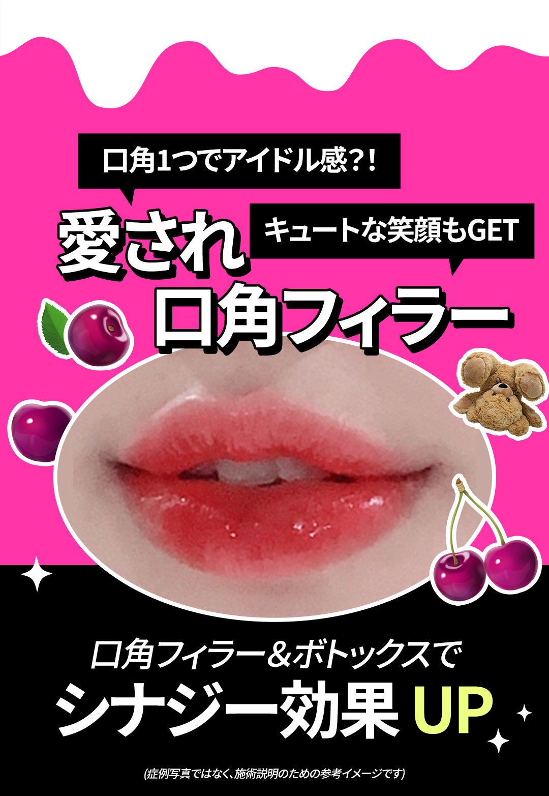 Filler khóe miệng & Botox hướng đến ấn tượng nụ cười tự nhiên｜Thủ thuật thiết kế chọn từ 3 loại｜Phòng khám Jfeel Hongdae