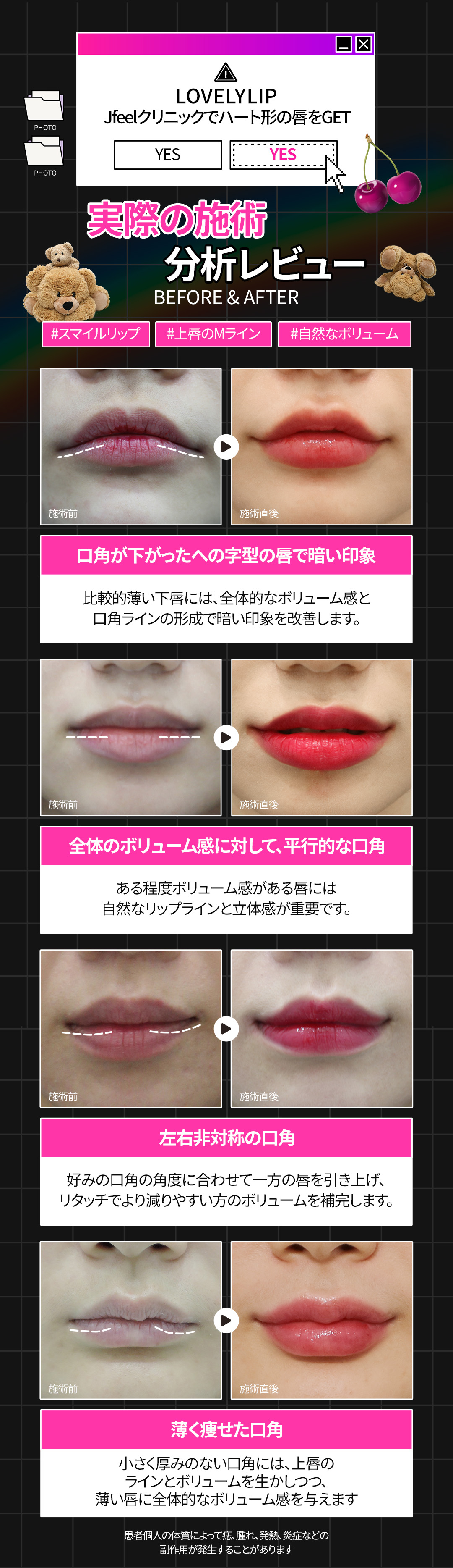 Filler khóe miệng & Botox hướng đến ấn tượng nụ cười tự nhiên｜Thủ thuật thiết kế chọn từ 3 loại｜Phòng khám Jfeel Hongdae