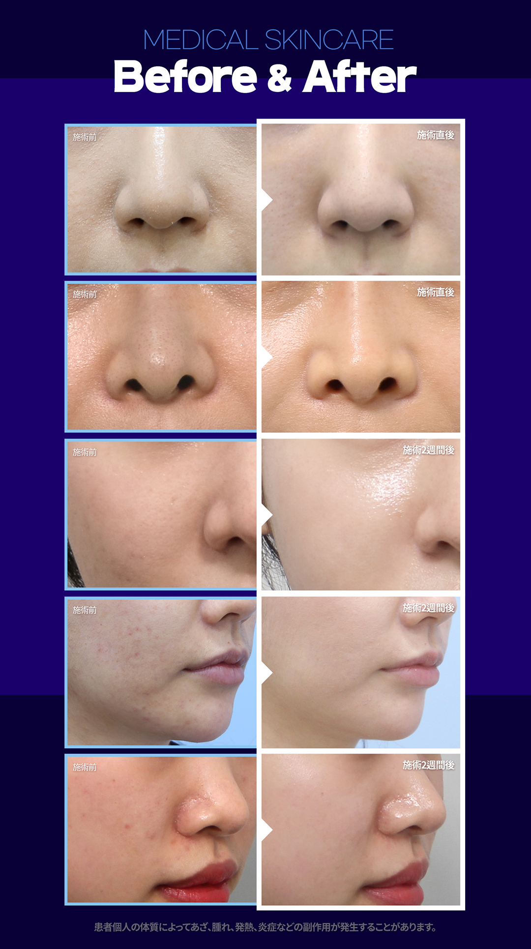 Chăm sóc da y khoa Gangnam Hàn Quốc | Liệu trình tùy chỉnh theo vấn đề da từ 5.954 yên tại Phòng khám Jfeel