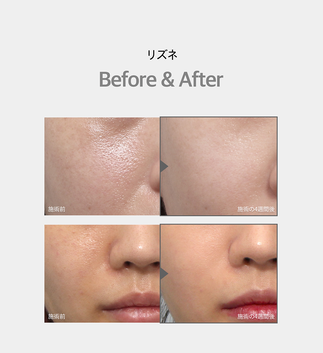 Lizne Skin Booster tiêm PN có nguồn gốc từ cá hồi hướng tới da căng