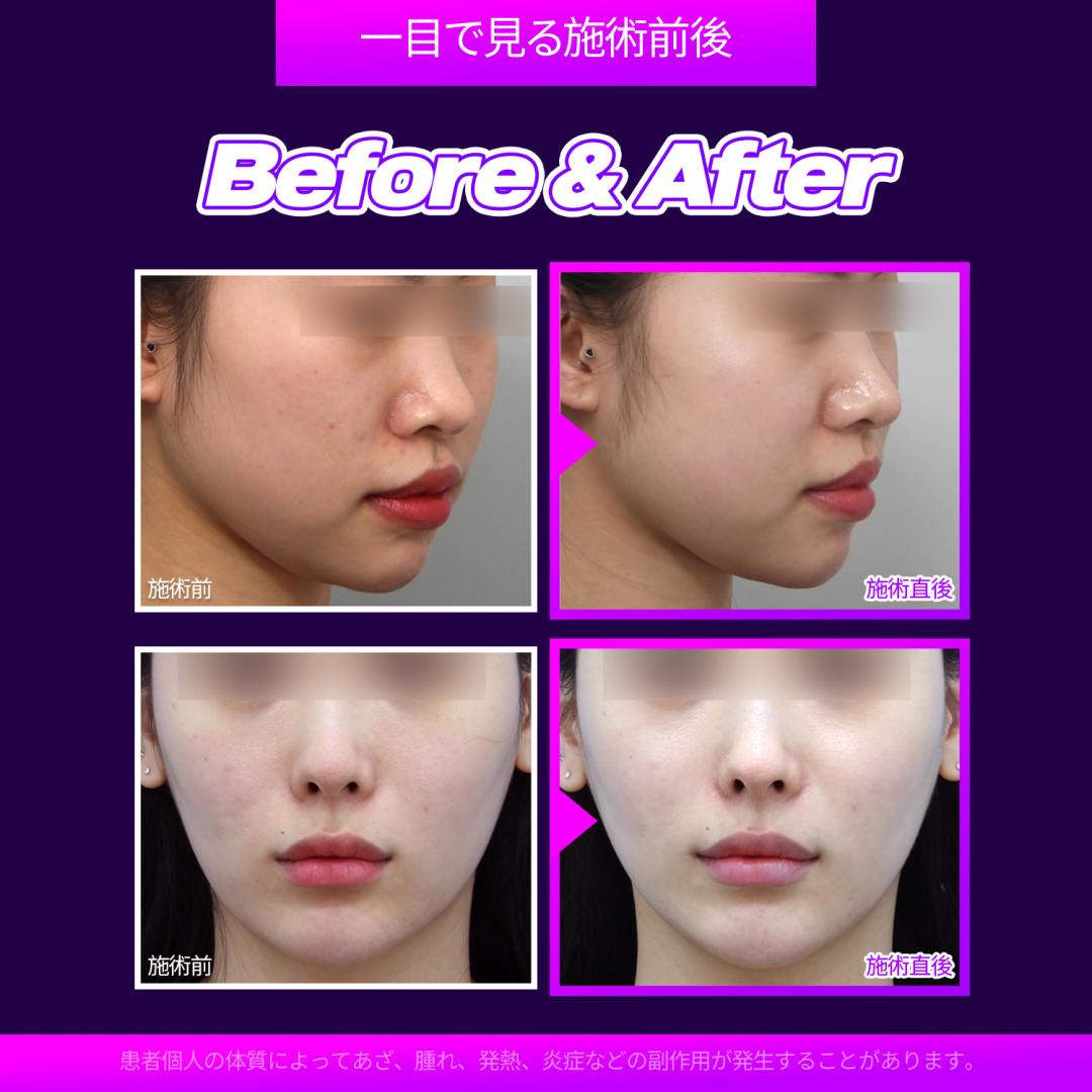 Lala Peeling | Giới thiệu liệu trình peel dưỡng ẩm kích ứng thấp dễ thực hiện