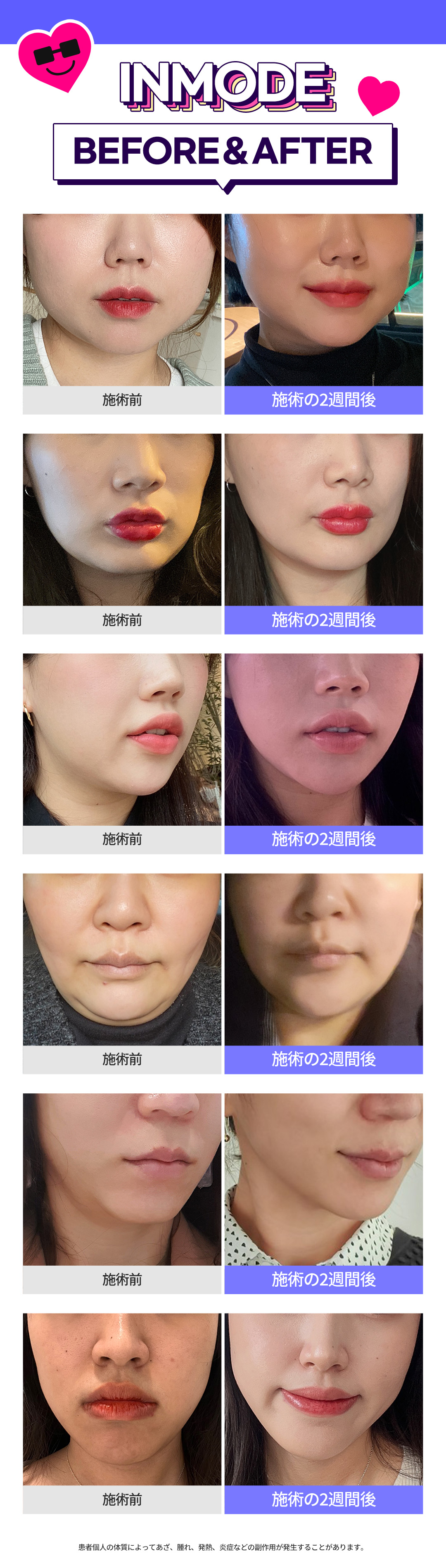 InMode RF cao tần | Giảm mỡ + nâng cơ cải thiện V-line | J Feel Gangnam