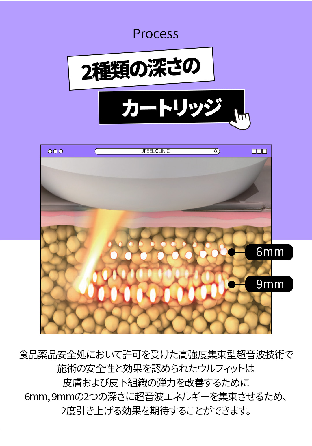 Tiêm tan mỡ & Body HIFU từ 6,550 yên | Hỗ trợ giảm mỡ cục bộ với công thức NO steroid | Jfeel Clinic Hongdae