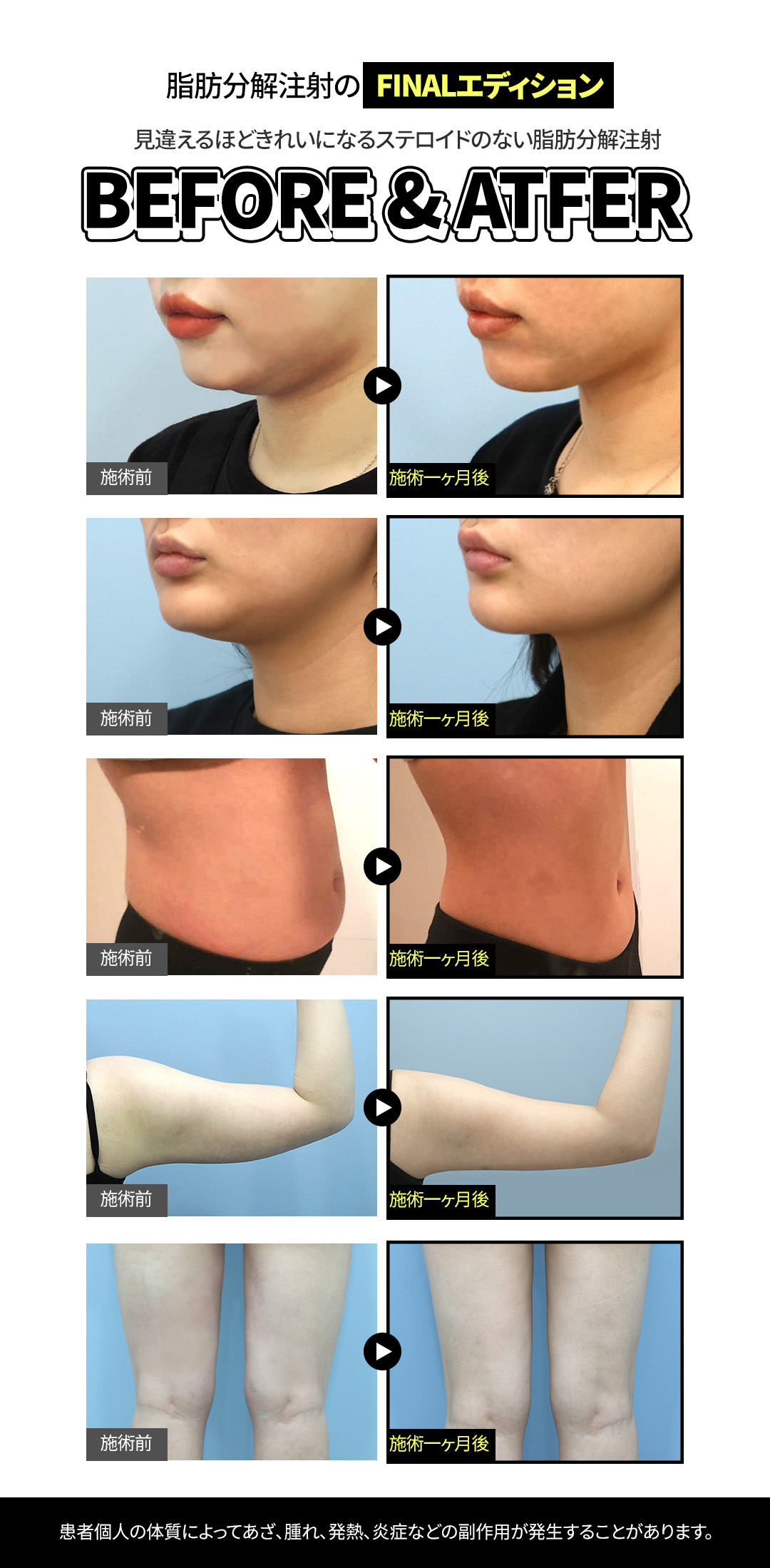 Tiêm tan mỡ & Body HIFU từ 6,550 yên | Hỗ trợ giảm mỡ cục bộ với công thức NO steroid | Jfeel Clinic Hongdae