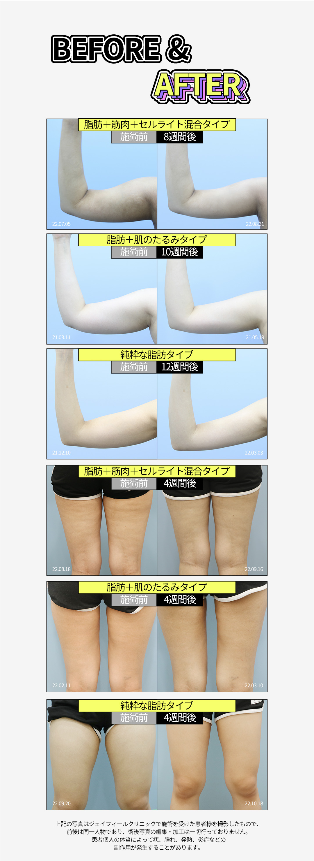 Tiêm tan mỡ & Body HIFU từ 6,550 yên | Hỗ trợ giảm mỡ cục bộ với công thức NO steroid | Jfeel Clinic Hongdae