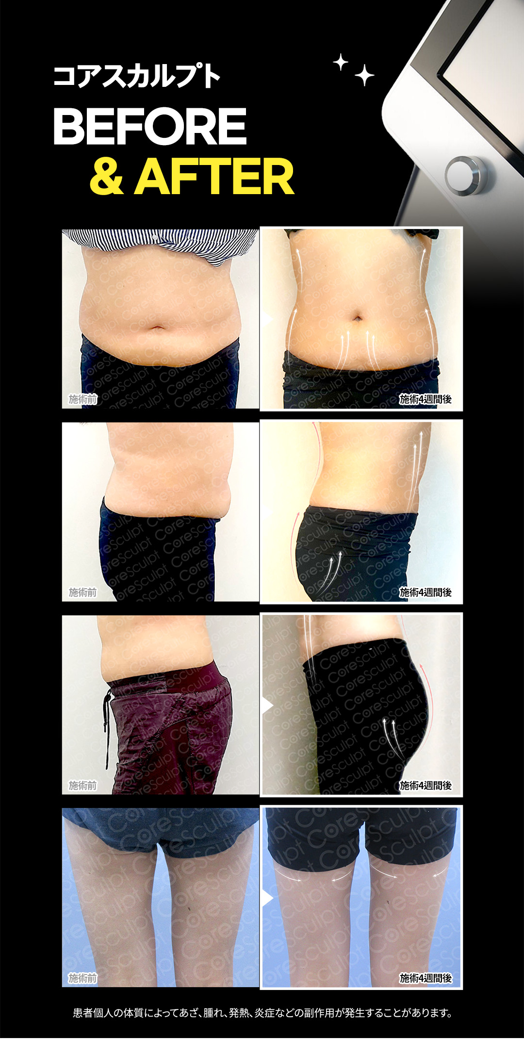 Tiêm tan mỡ & Body HIFU từ 6,550 yên | Hỗ trợ giảm mỡ cục bộ với công thức NO steroid | Jfeel Clinic Hongdae