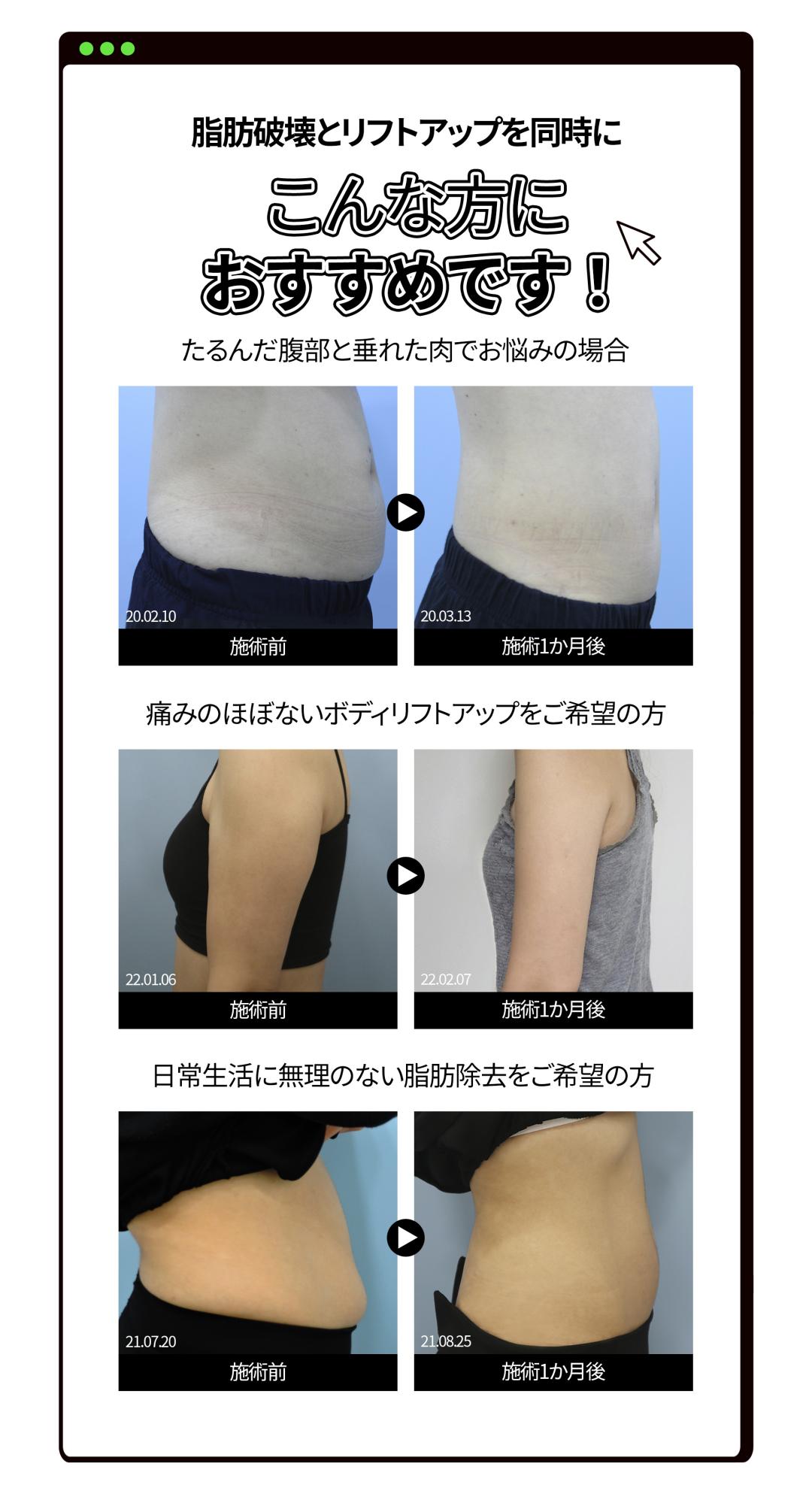 Tiêm tan mỡ & Body HIFU từ 6,550 yên | Hỗ trợ giảm mỡ cục bộ với công thức NO steroid | Jfeel Clinic Hongdae