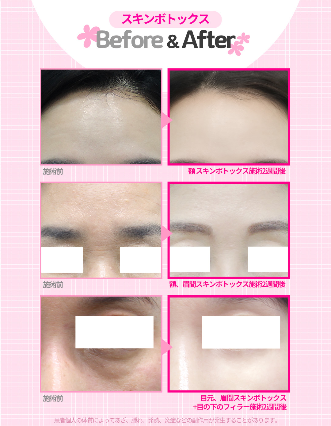 Skin Botox Phòng khám Jfeel Hongdae｜Thủ thuật da đẹp hướng đến cải thiện độ căng da trán・vùng mắt【Từ 7.145 yên】