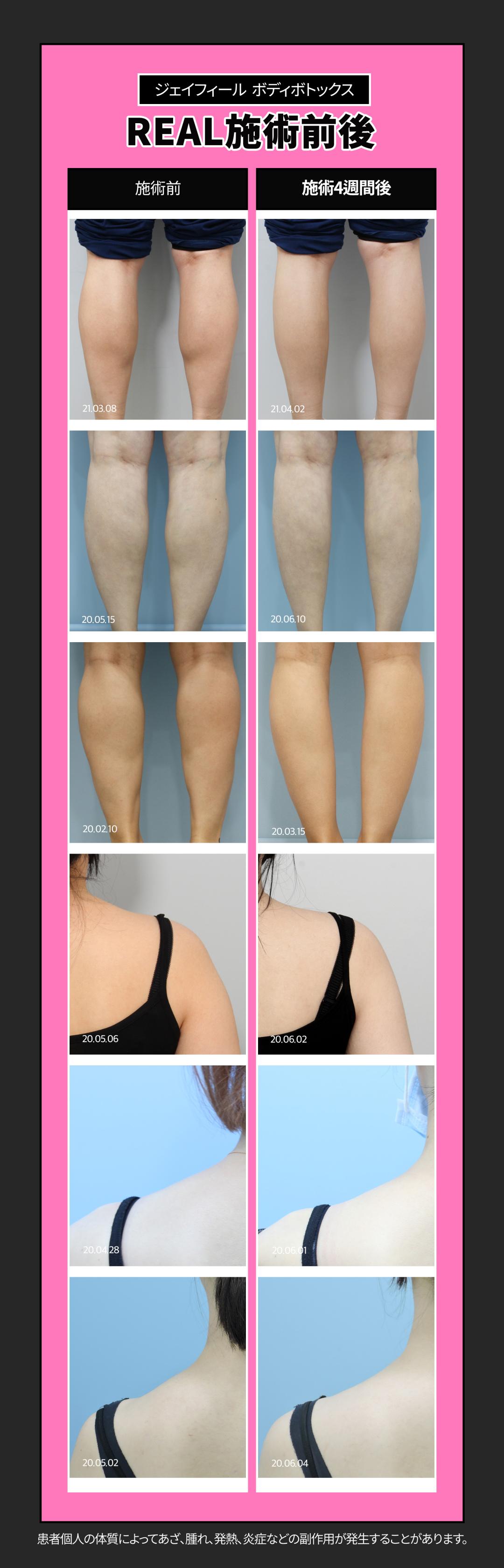 Thủ thuật Body Botox｜Hướng đến cải thiện bắp chân・vai・mồ hôi nhiều｜Phòng khám Jfeel Seoul Gangnam