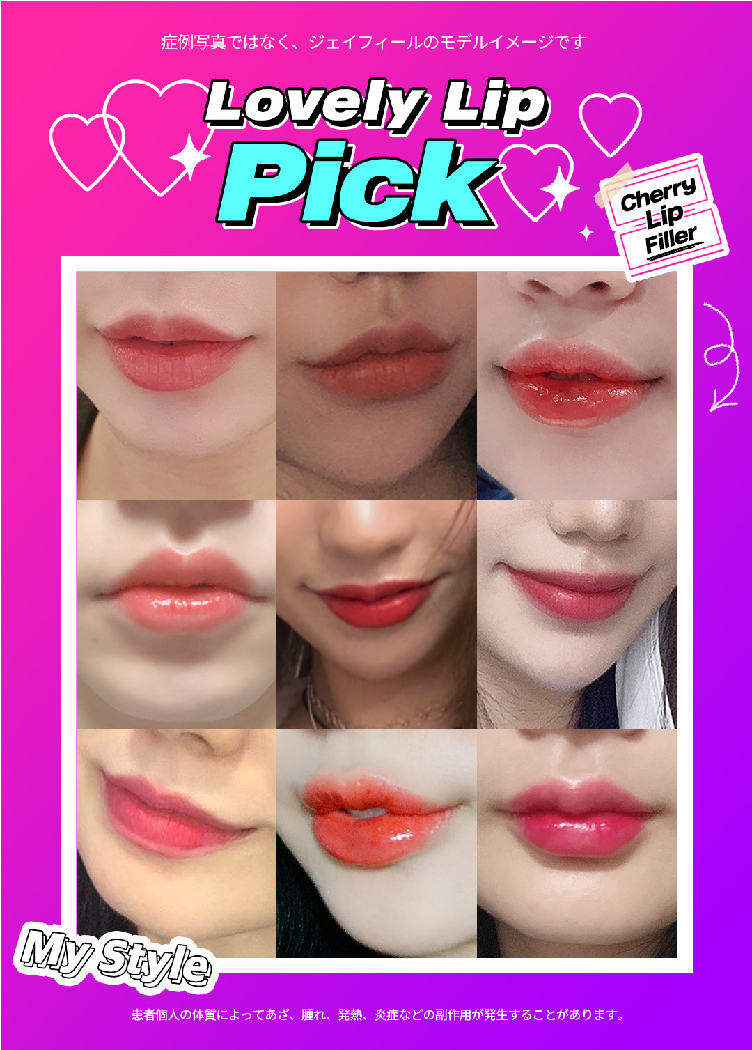 【Phòng khám Jfeel Hongdae】Filler Hyaluronic Acid môi・mũi・trán｜Thủ thuật thẩm mỹ Hàn Quốc hướng đến độ nổi tự nhiên với tùy chỉnh theo vùng