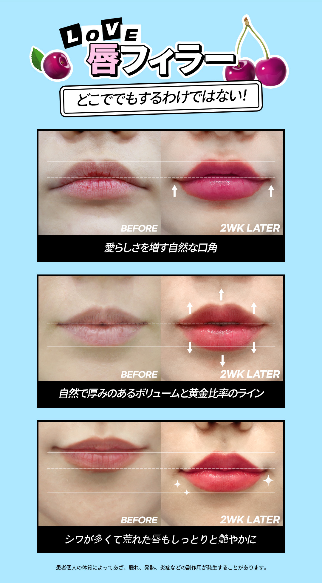 【Phòng khám Jfeel Hongdae】Filler Hyaluronic Acid môi・mũi・trán｜Thủ thuật thẩm mỹ Hàn Quốc hướng đến độ nổi tự nhiên với tùy chỉnh theo vùng