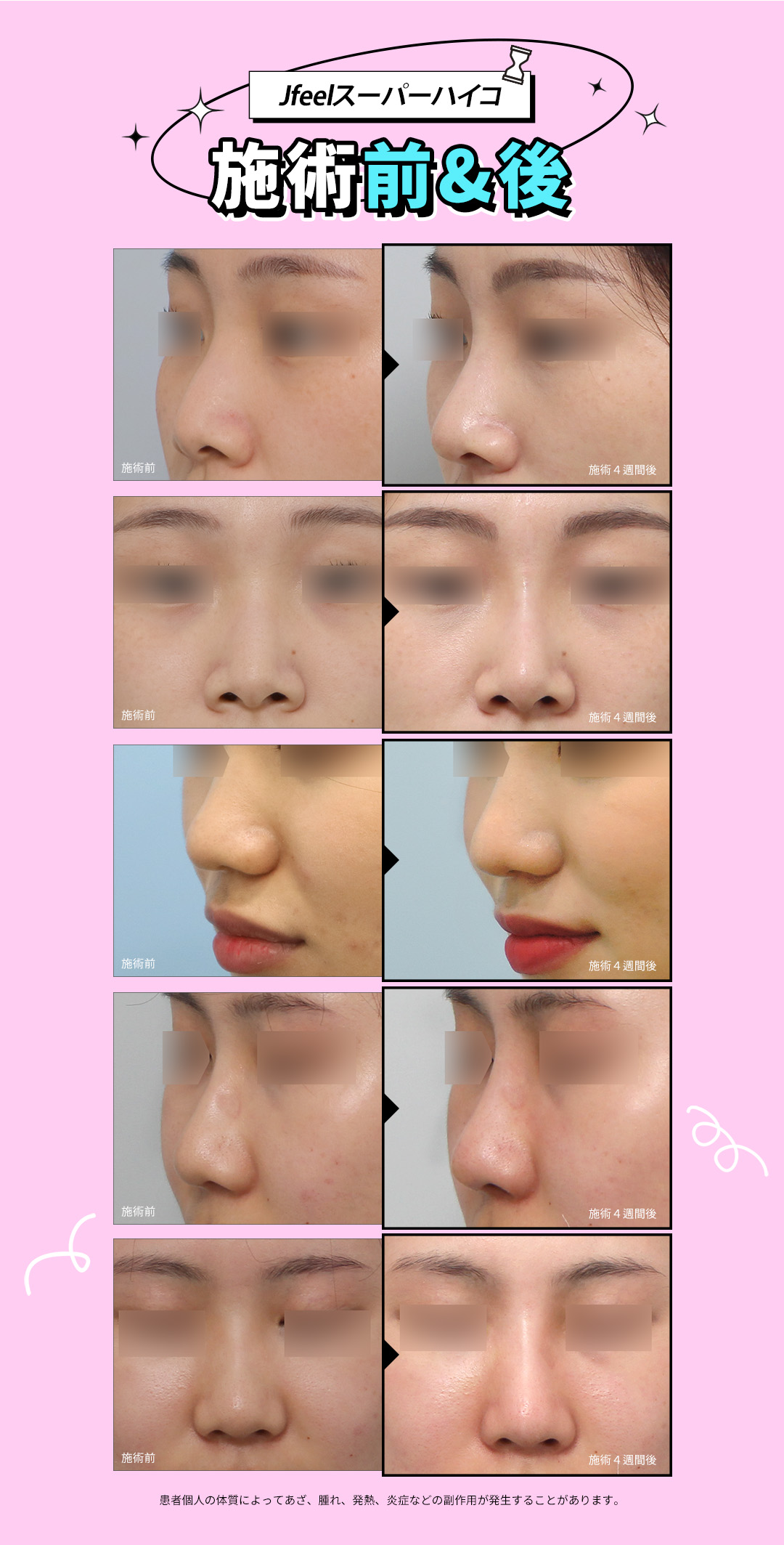 【Phòng khám Jfeel Hongdae】Filler Hyaluronic Acid môi・mũi・trán｜Thủ thuật thẩm mỹ Hàn Quốc hướng đến độ nổi tự nhiên với tùy chỉnh theo vùng