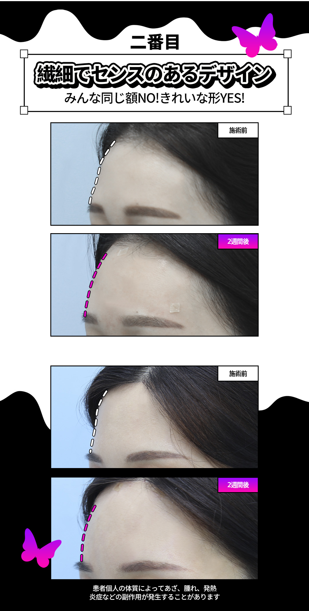 【Phòng khám Jfeel Hongdae】Filler Hyaluronic Acid môi・mũi・trán｜Thủ thuật thẩm mỹ Hàn Quốc hướng đến độ nổi tự nhiên với tùy chỉnh theo vùng