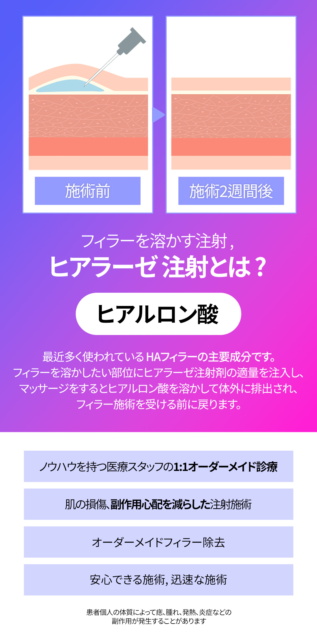 【Phòng khám Jfeel Hongdae】Filler Hyaluronic Acid môi・mũi・trán｜Thủ thuật thẩm mỹ Hàn Quốc hướng đến độ nổi tự nhiên với tùy chỉnh theo vùng