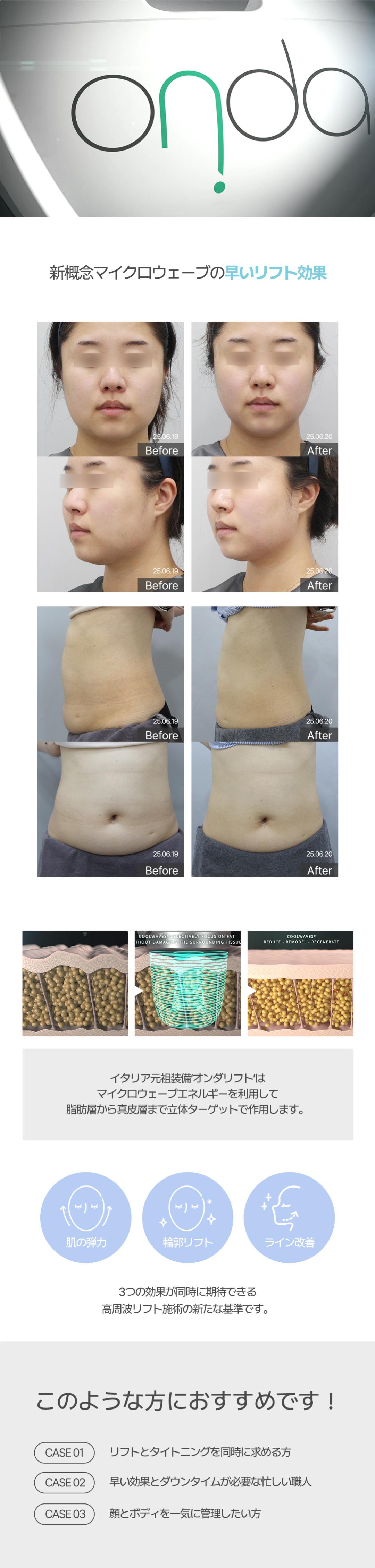 ONDA Lift cải thiện độ đàn hồi da & đường viền | Nâng cơ thế hệ mới không cần gây tê | Phòng khám Jfeel chi nhánh Hongdae