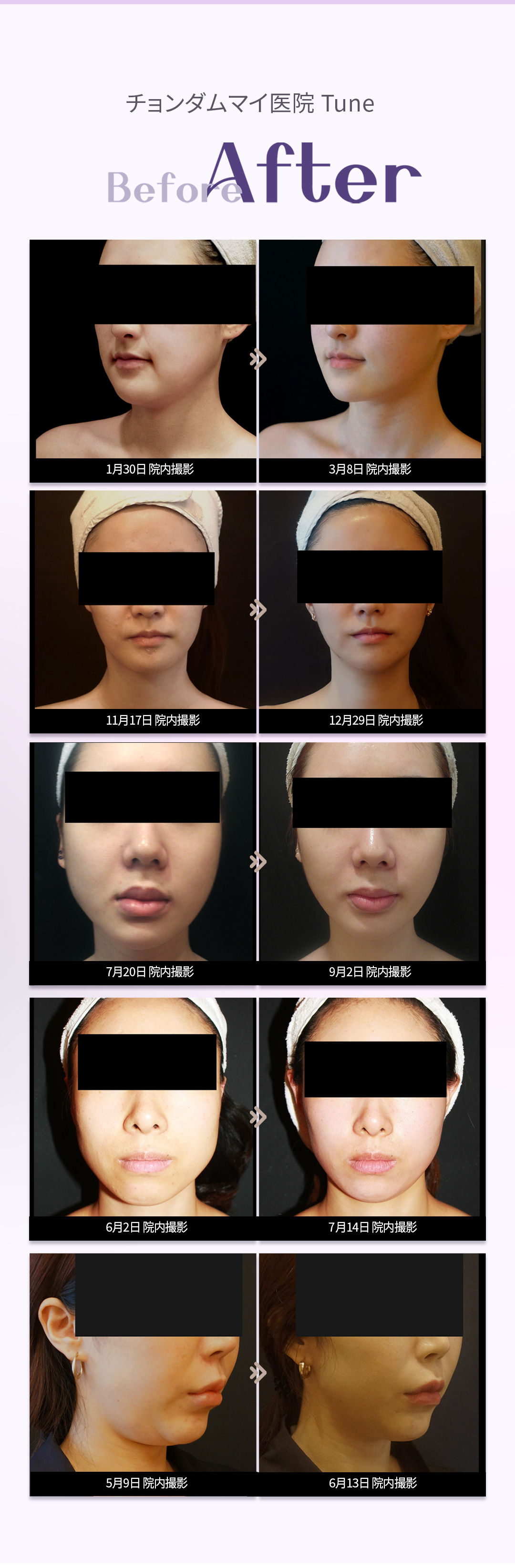 Tune Face Lifting | Chăm sóc độ đàn hồi da và chảy xệ bằng sóng cao tần Israel | Phòng khám Cheongdam My Seoul Gangnam