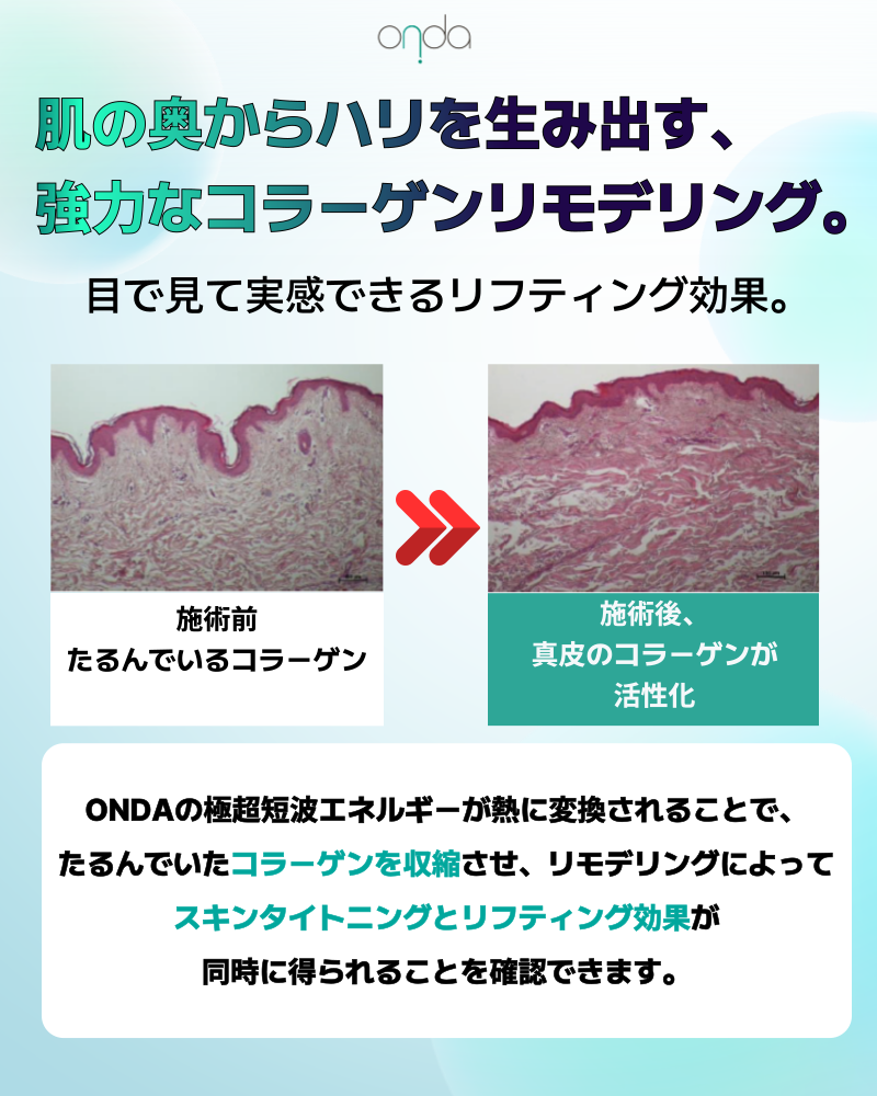 ONDA Lifting Hàn Quốc｜Sóng cực ngắn thế hệ 4 hướng đến cải thiện chảy xệ, nọng cằm｜Viện Olpiche Gangnam