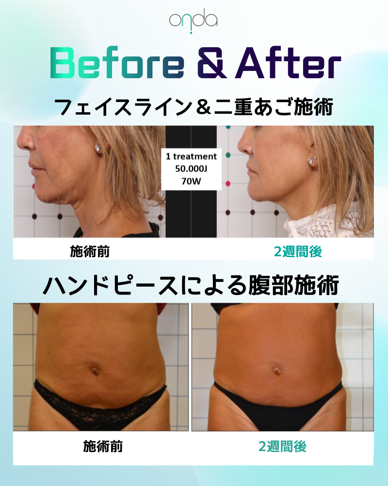 ONDA Lifting Hàn Quốc｜Sóng cực ngắn thế hệ 4 hướng đến cải thiện chảy xệ, nọng cằm｜Viện Olpiche Gangnam