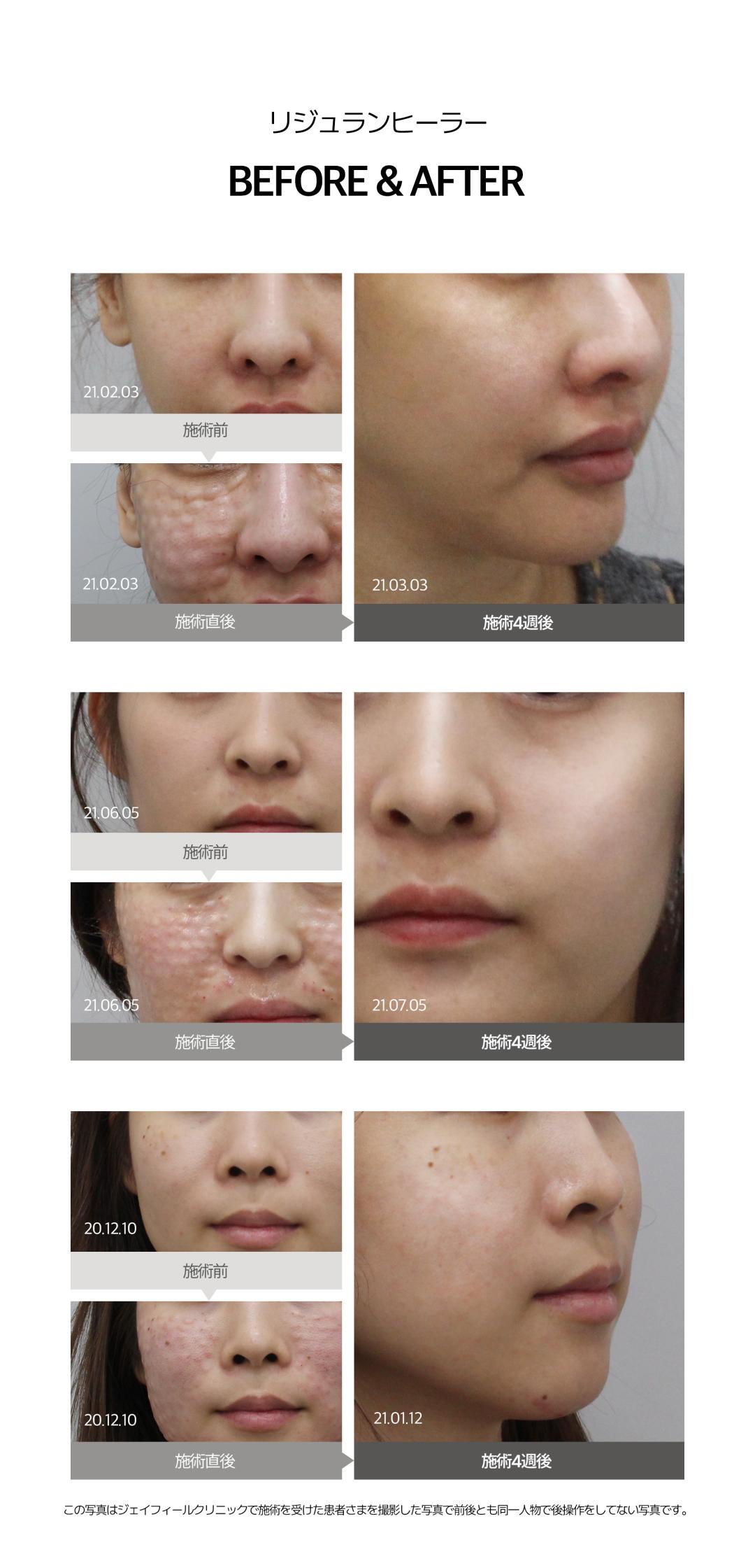 Rejuran Healer | Liệu trình Skin Booster chứa thành phần PN có nguồn gốc từ cá hồi