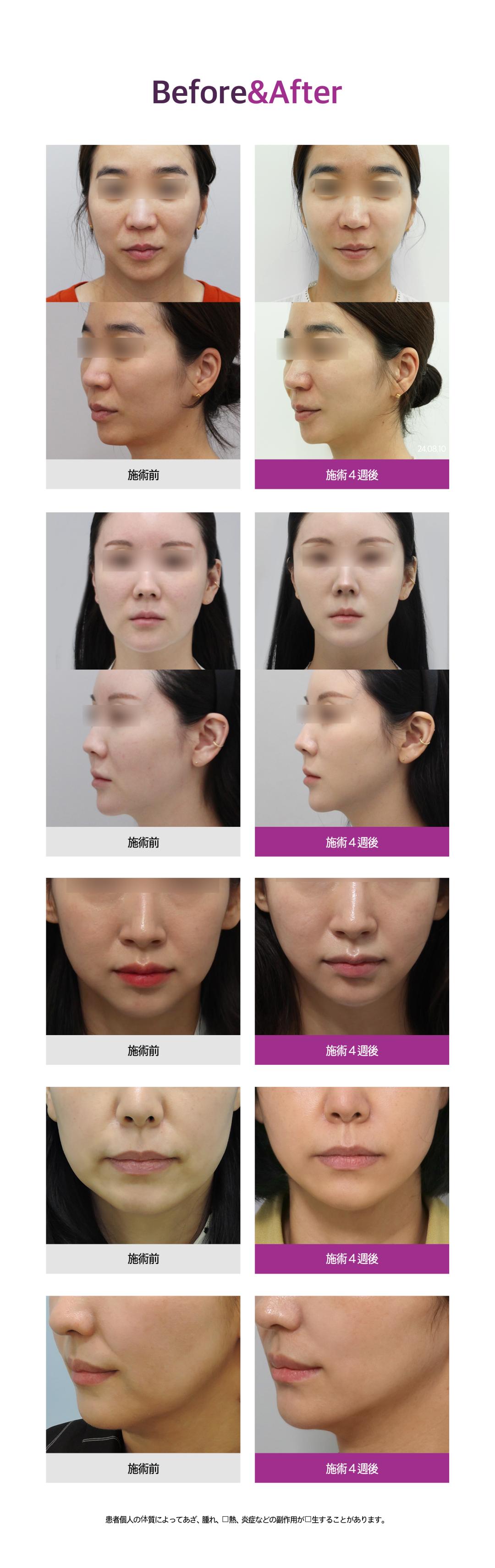 Thermage FLX｜Nhắm đến nâng và cải thiện chảy xệ bằng tái tạo collagen｜Phòng khám Jfeel chi nhánh Hongdae