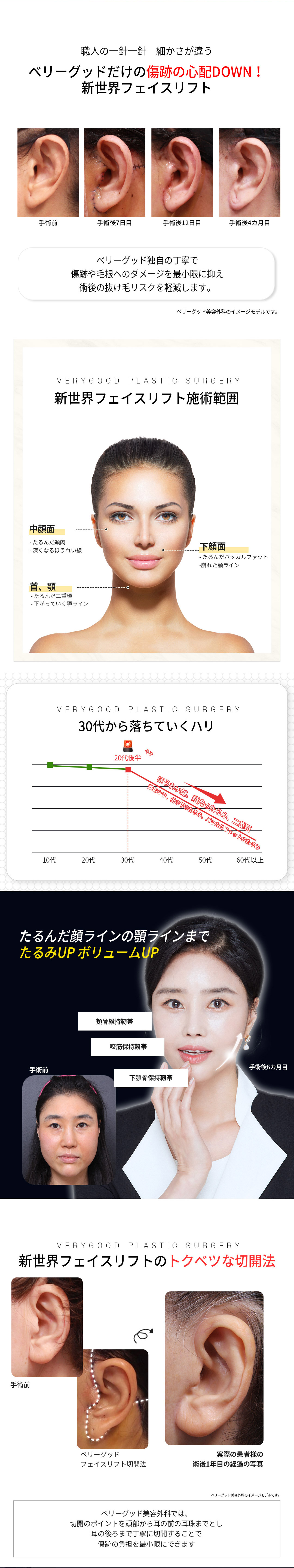 Căng da mặt New World | Phẫu thuật nâng cơ cải thiện chảy xệ và nếp nhăn | Very Good - Gangnam