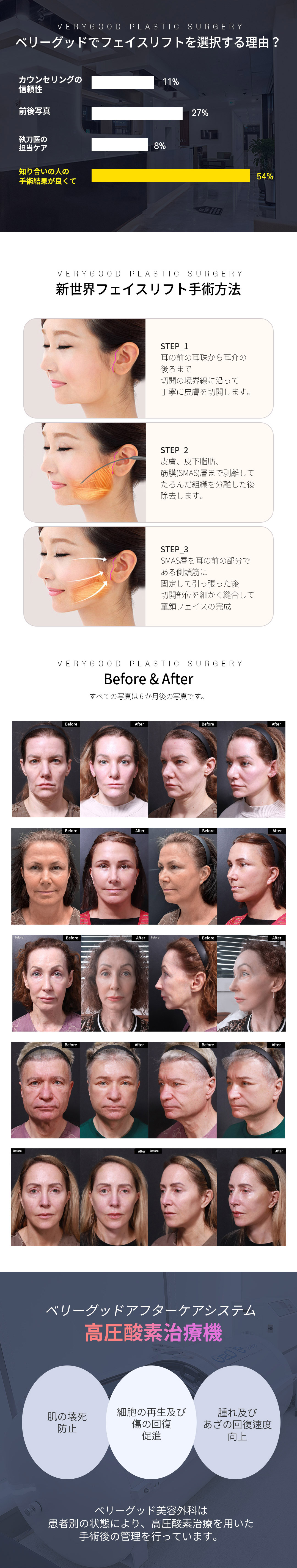 Căng da mặt New World | Phẫu thuật nâng cơ cải thiện chảy xệ và nếp nhăn | Very Good - Gangnam