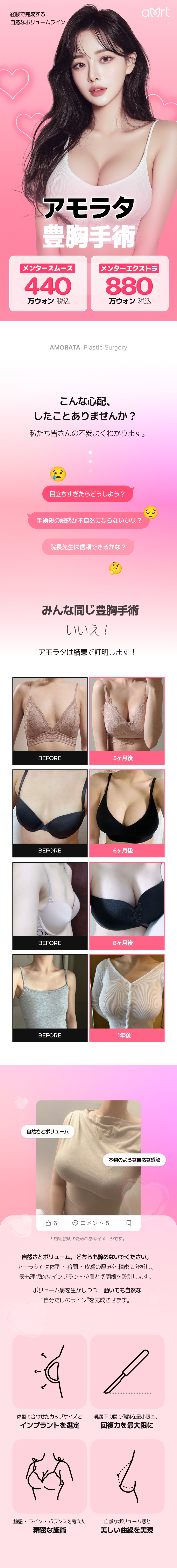 Phẫu thuật nâng ngực với Mentor Implant | Hướng tới đường nét tự nhiên | Ga Gangnam Amorata Plastic Surgery