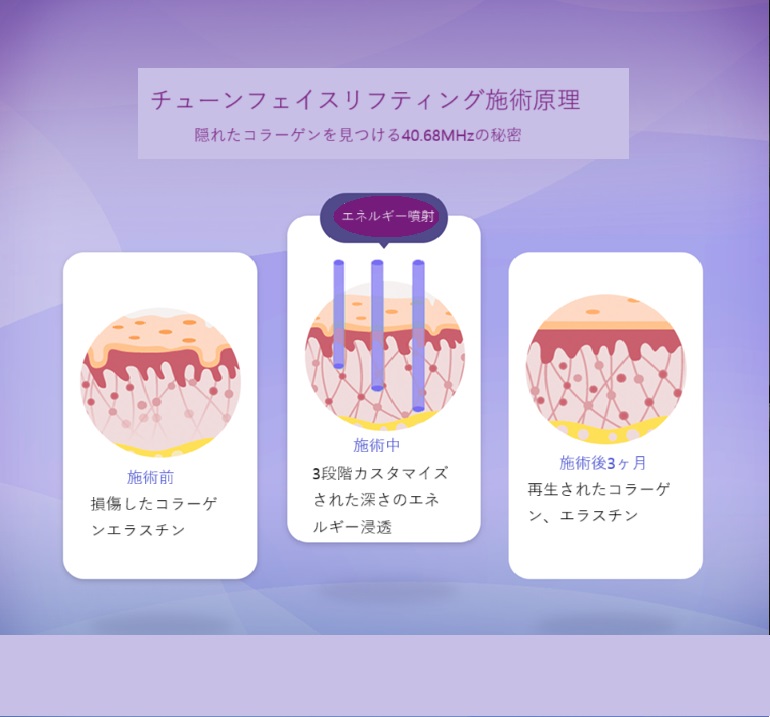 Accent Prime Tune Face｜Tạo collagen với RF Lifting 40.68MHz｜Viện Rizeon With Yonsei Slimline Apgujeong