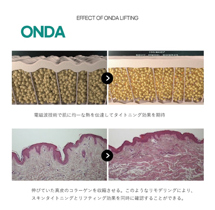 Nhắm đến săn chắc và nâng da bằng Onda Lift (ONDA LIFTING)｜Seoul Apgujeongrodeo stn.・Phòng khám BLS