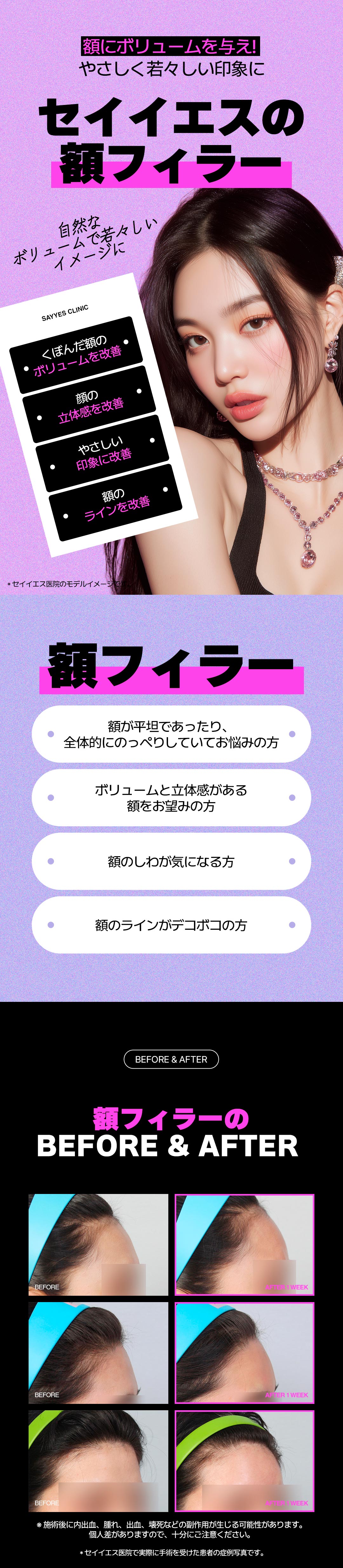 Tiêm Hyaluronic Acid trán 3CC｜Thủ thuật 10 phút hướng đến trán tròn lập thể｜Phòng khám Say Yes Gangnam Seoul