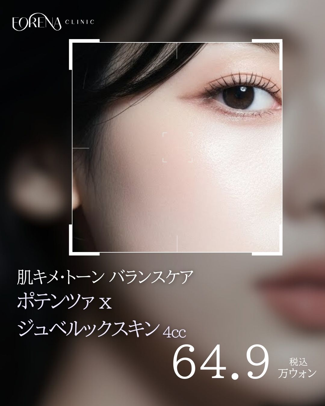 【Hongdae】Phòng khám Forena | Potenza × Juvelook 4cc | Gói chăm sóc lỗ chân lông, làm mịn da, độ đàn hồi GIẢM 37%