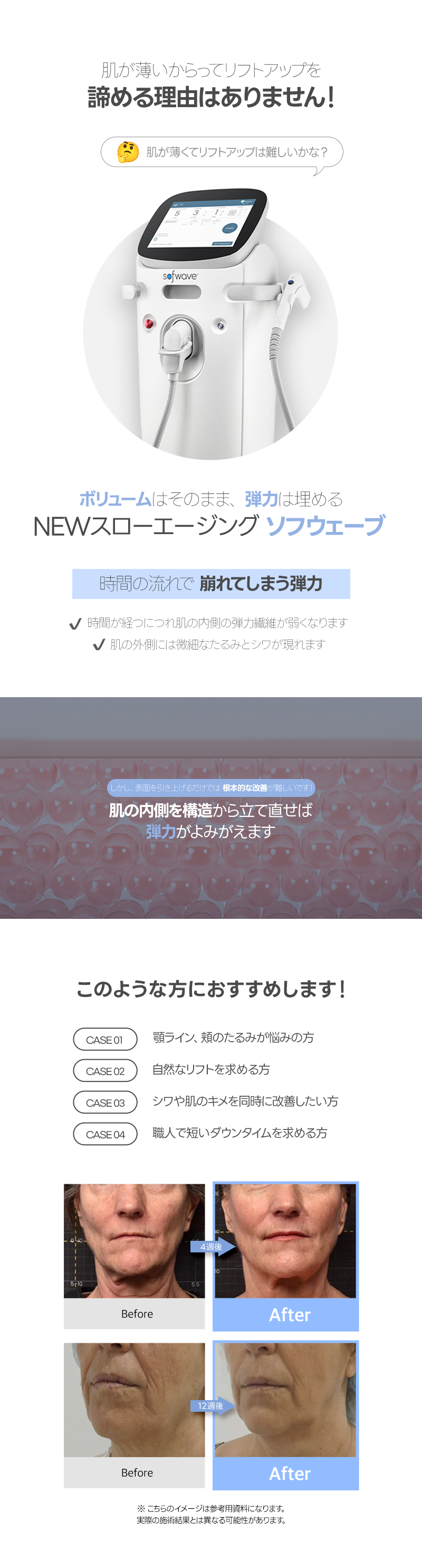 Sofwave Lift | Cải thiện chảy xệ và chăm sóc độ đàn hồi an tâm cho cả người da mỏng | Jfeel Phòng khám Gangnam