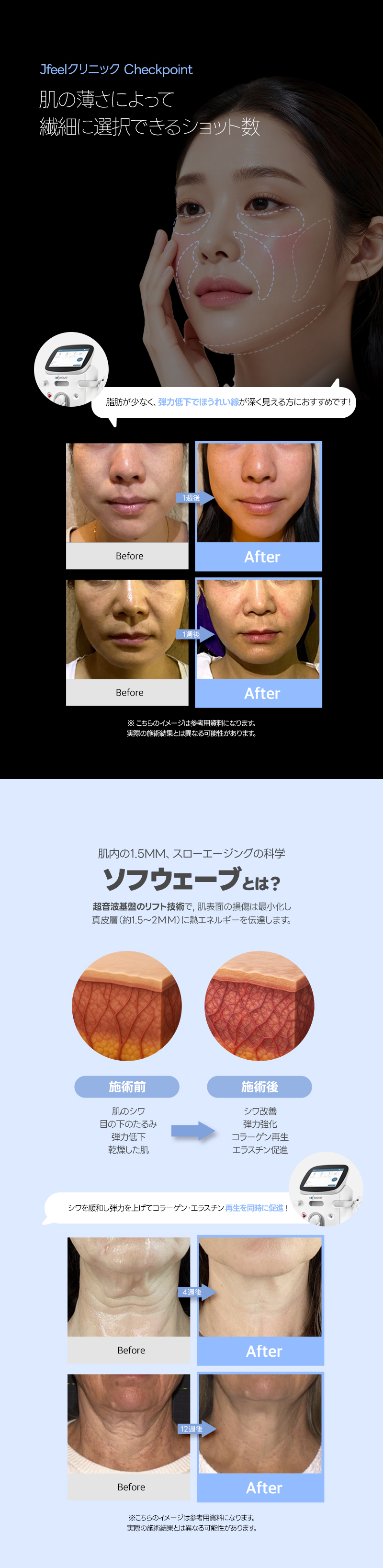 Sofwave Lift | Cải thiện chảy xệ và chăm sóc độ đàn hồi an tâm cho cả người da mỏng | Jfeel Phòng khám Gangnam