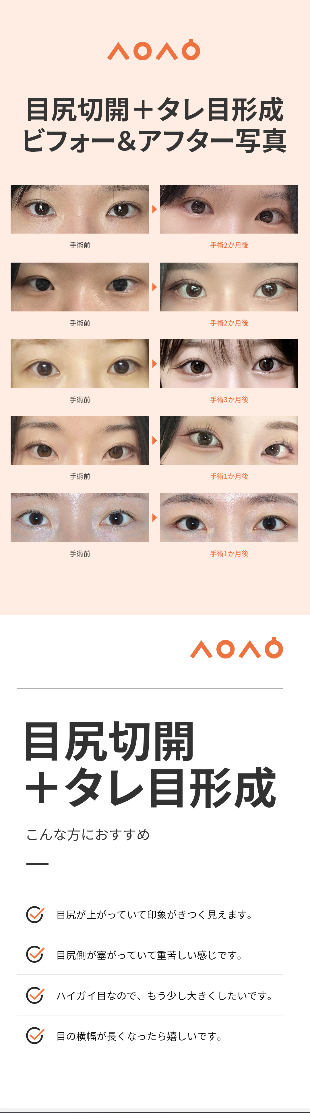 Cắt đuôi mắt + Tạo mắt cụp | Thiết kế tự nhiên bởi bác sĩ chuyên khoa thẩm mỹ | Phòng khám Sai Thẩm mỹ (Seoul Apgujeong)