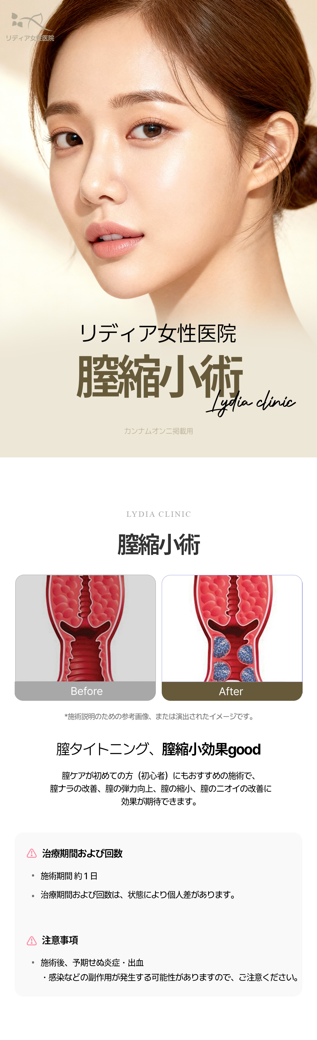 Phẫu thuật thu hẹp âm đạo tại Lidia Women's Clinic | Phòng khám chuyên về phụ nữ ở Gangnam, Seoul, Hàn Quốc