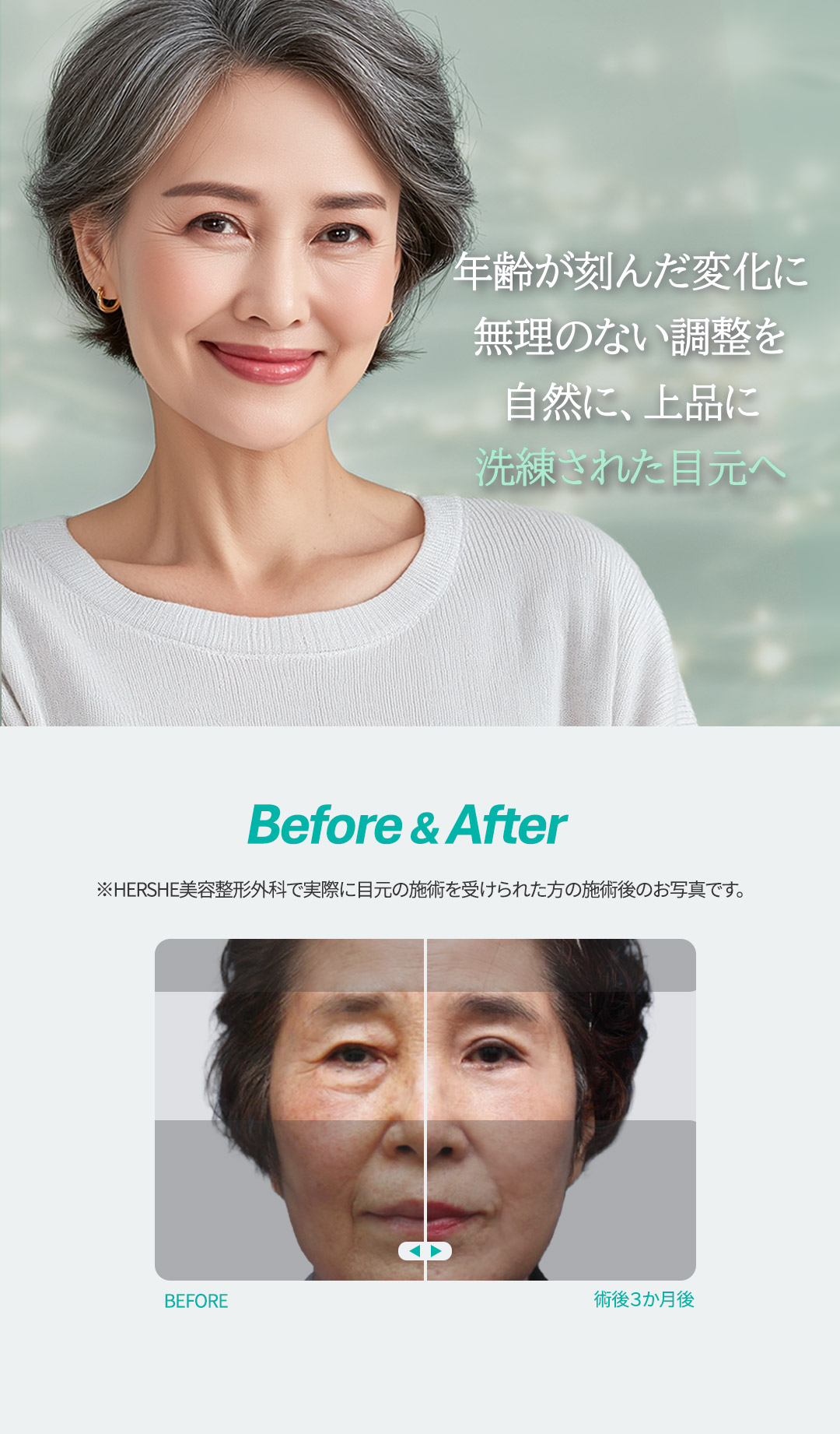 Phẫu thuật trẻ hóa vùng mắt | Mí trên・Mí dưới・Cắt dưới lông mày hướng tới vẻ trẻ trung tự nhiên | HERSHE Plastic Surgery (Cheongdam-dong)