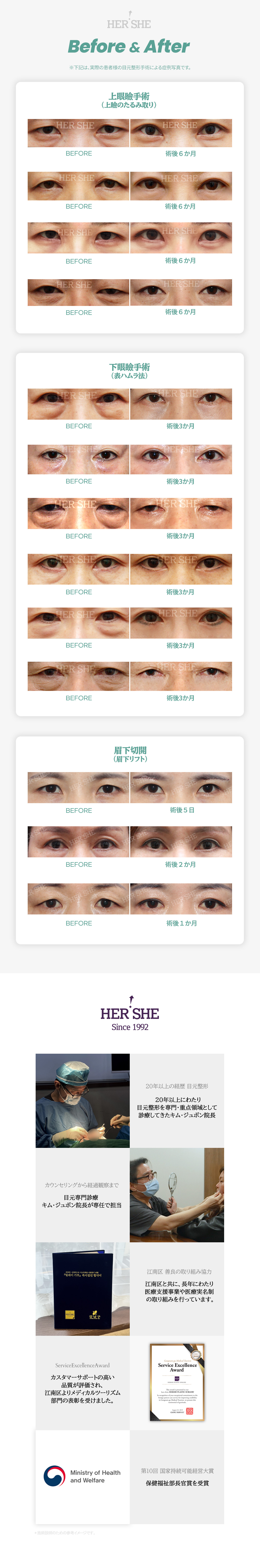 Phẫu thuật trẻ hóa vùng mắt | Mí trên・Mí dưới・Cắt dưới lông mày hướng tới vẻ trẻ trung tự nhiên | HERSHE Plastic Surgery (Cheongdam-dong)