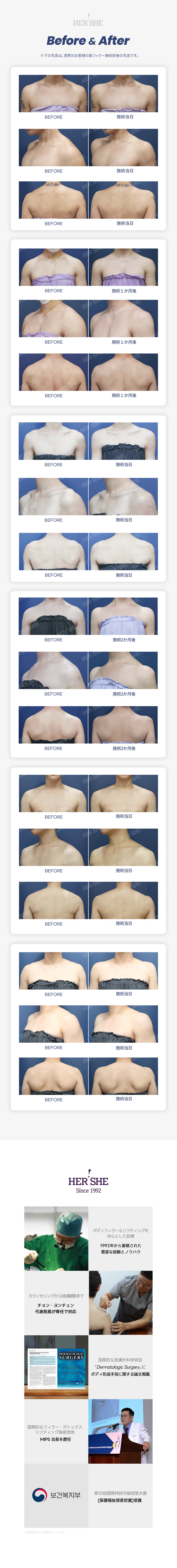 Thủ thuật filler vai nam｜Hướng đến cải thiện vai xuôi・vai hẹp｜Phẫu thuật Thẩm mỹ HERSHE Cheongdam