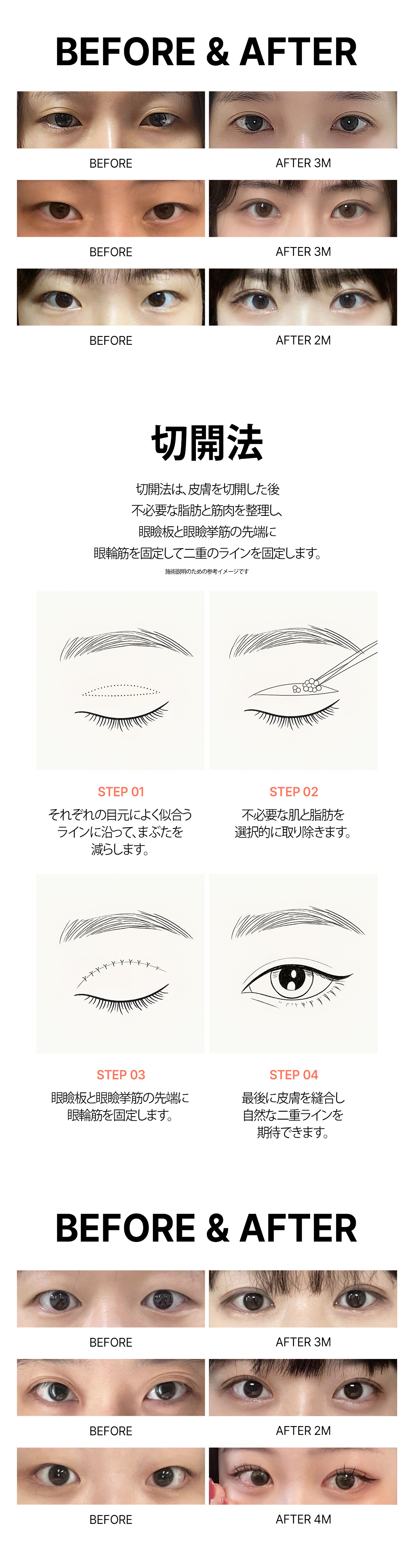 Phẫu thuật mí đôi Hàn Quốc | Bấm mí từ 490.000 won, cũng đáp ứng cắt mí | Thiết kế cá nhân bởi bác sĩ chuyên khoa | Phòng khám Sai Thẩm mỹ