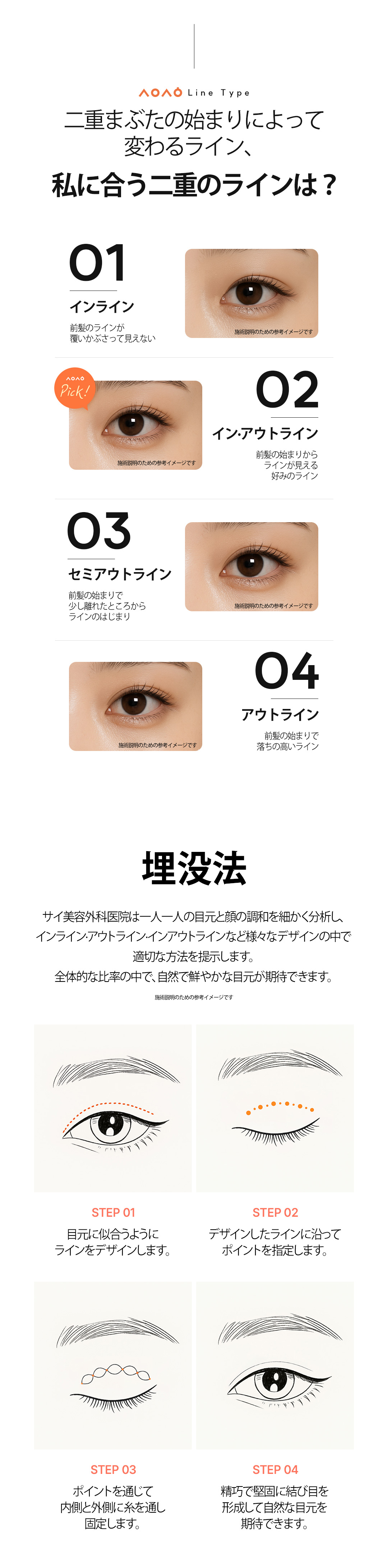 Phẫu thuật mí đôi Hàn Quốc | Bấm mí từ 490.000 won, cũng đáp ứng cắt mí | Thiết kế cá nhân bởi bác sĩ chuyên khoa | Phòng khám Sai Thẩm mỹ