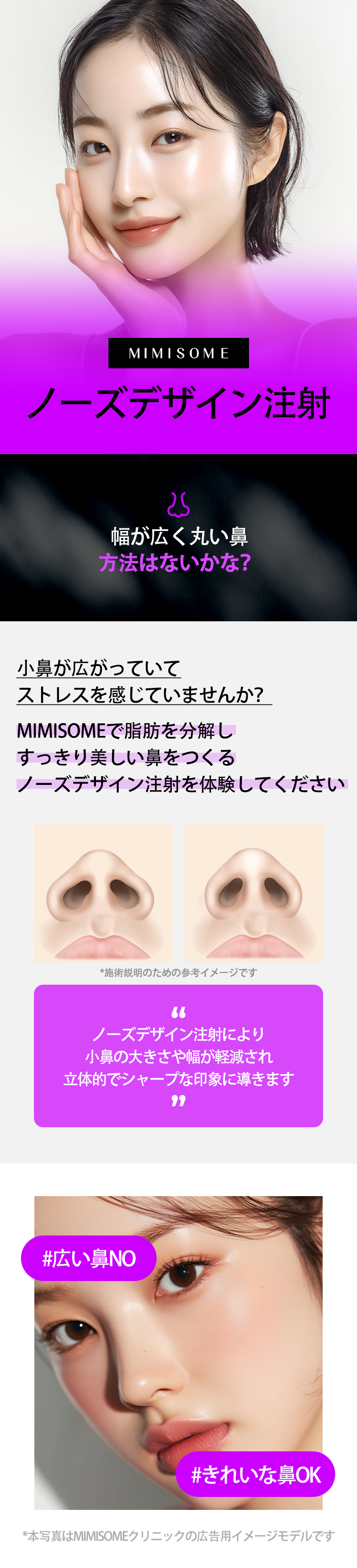 Tiêm thiết kế mũi Mimisom Busan cánh mũi gọn｜Hướng đến ấn tượng lập thể với chỉnh hình mũi không cắt
