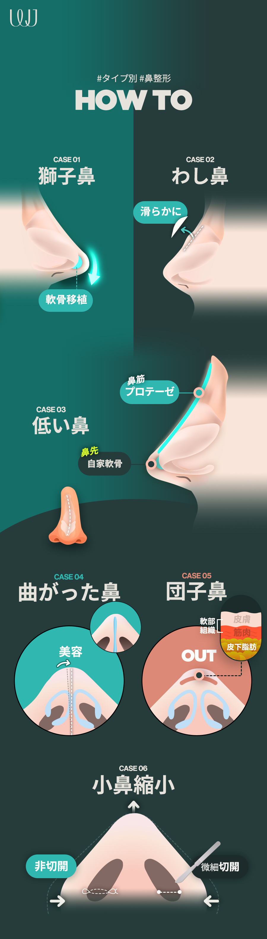 Nâng mũi Nachu Rực Rỡ | Nâng mũi kết hợp tự nhiên và rực rỡ | WJ Wonjin Phẫu thuật Thẩm mỹ・cách ga Gangnam 3 phút đi bộ