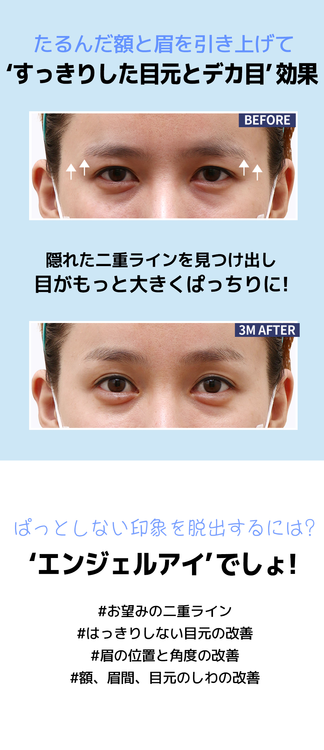 Nâng trán Angel Eye｜Hướng đến cải thiện chảy xệ mí mắt, sụp mày｜Viện thẩm mỹ WJ Wonjin (ga Gangnam)