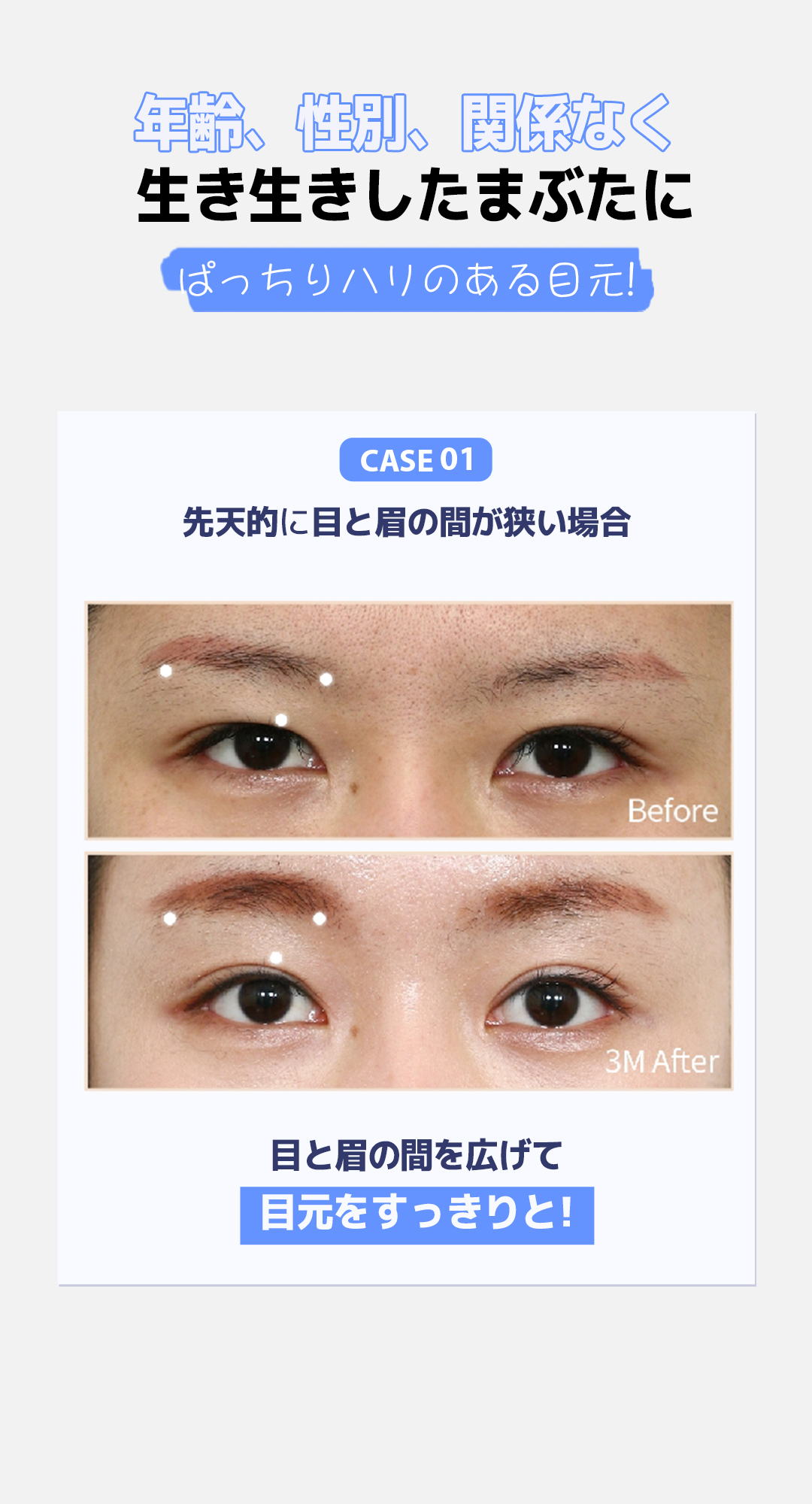 Nâng trán Angel Eye｜Hướng đến cải thiện chảy xệ mí mắt, sụp mày｜Viện thẩm mỹ WJ Wonjin (ga Gangnam)
