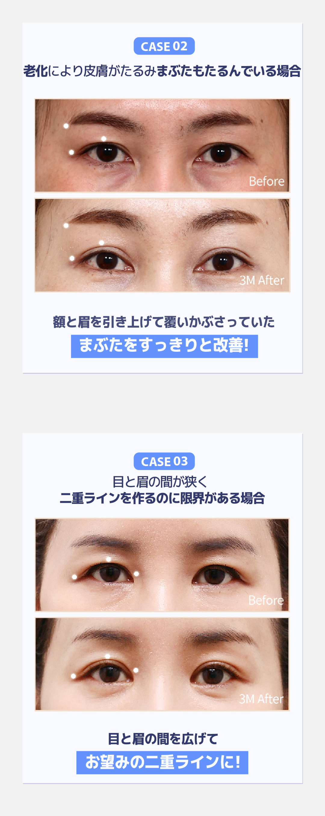 Nâng trán Angel Eye｜Hướng đến cải thiện chảy xệ mí mắt, sụp mày｜Viện thẩm mỹ WJ Wonjin (ga Gangnam)