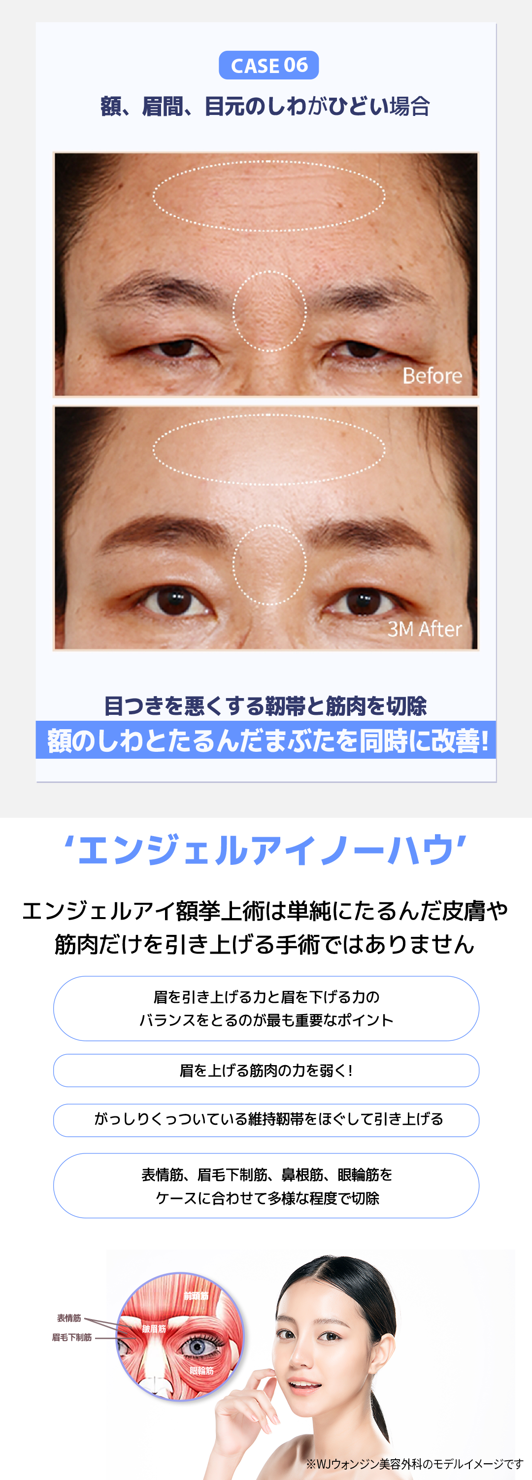 Nâng trán Angel Eye｜Hướng đến cải thiện chảy xệ mí mắt, sụp mày｜Viện thẩm mỹ WJ Wonjin (ga Gangnam)